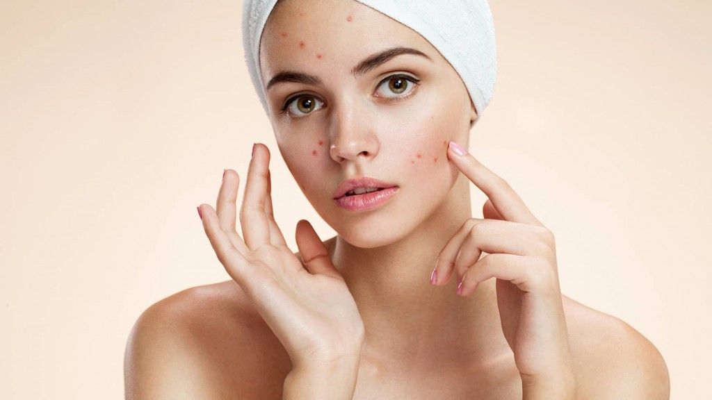 L'article sur l'acné du blog Vita Recherche